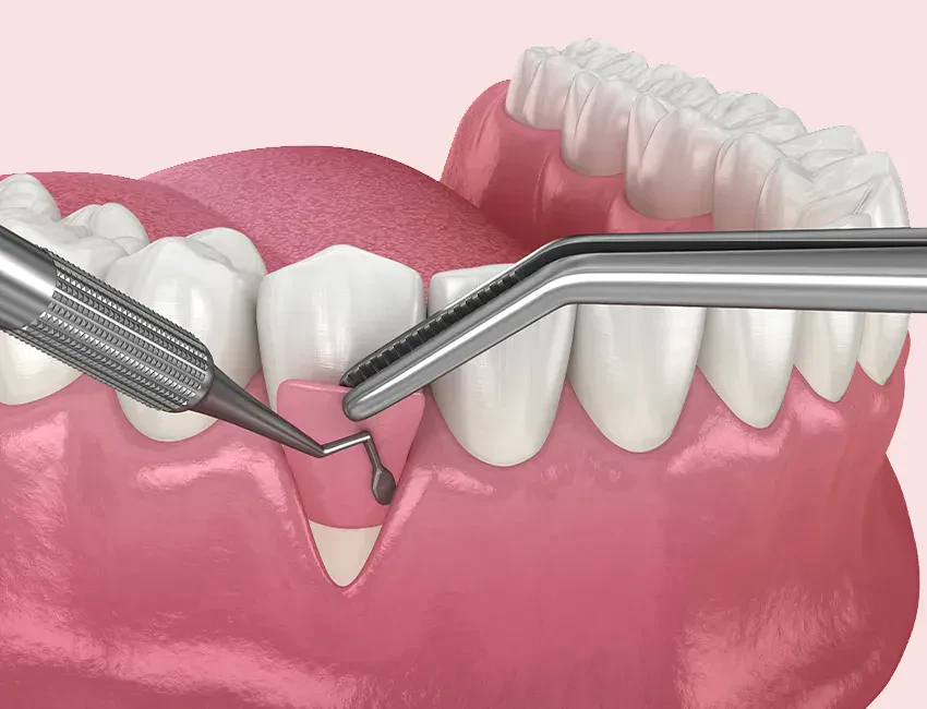What is Gum Grafting