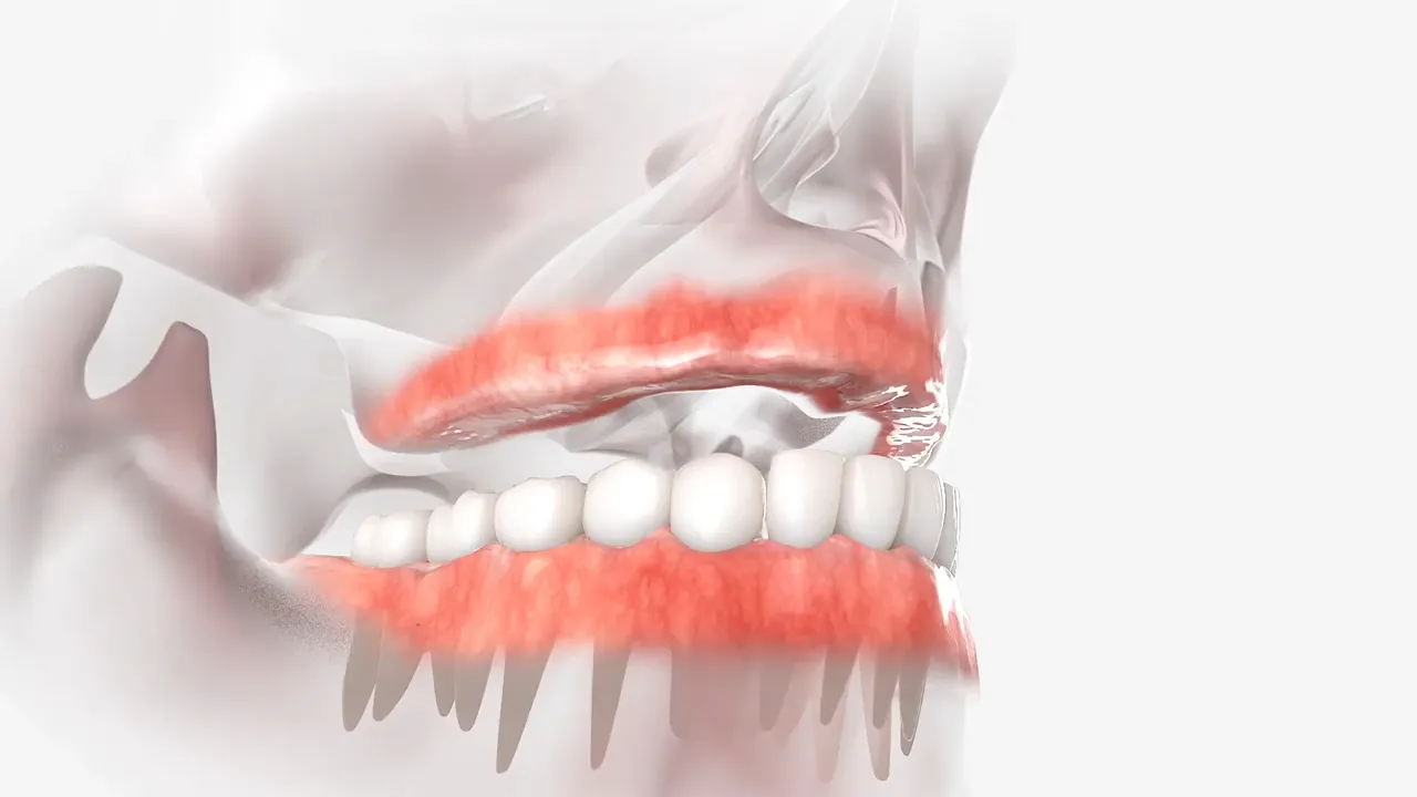 All-on-4 Dental Implants
