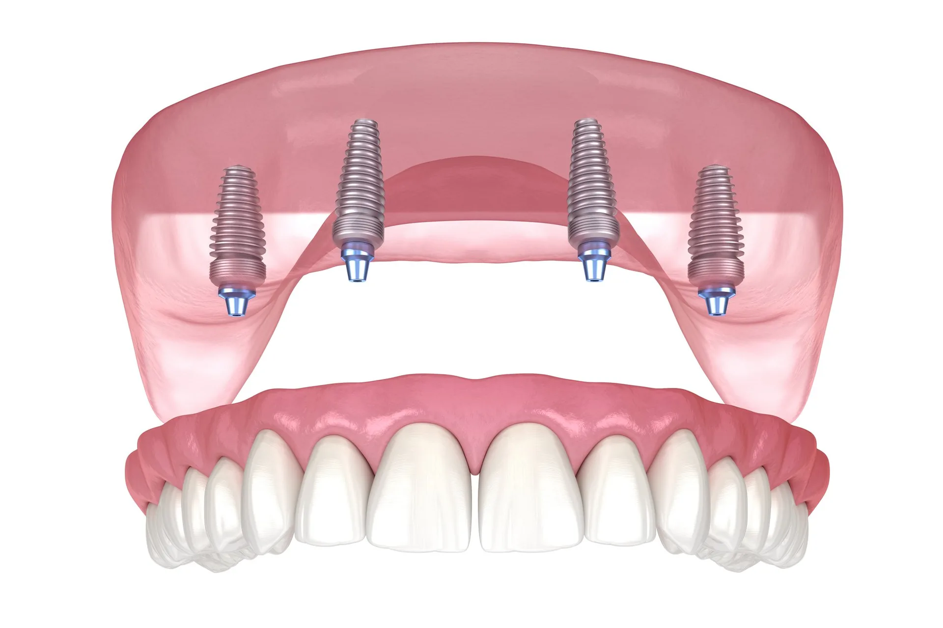all-on-4 patient model