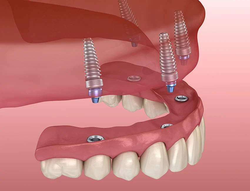 dental implants in Orange County