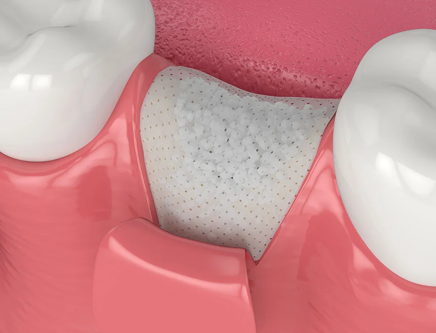 What is Sinus Lift