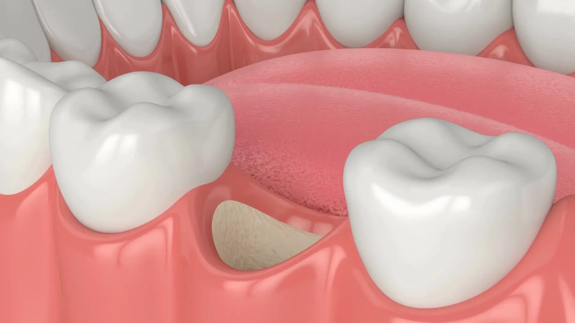 Bone Grafting