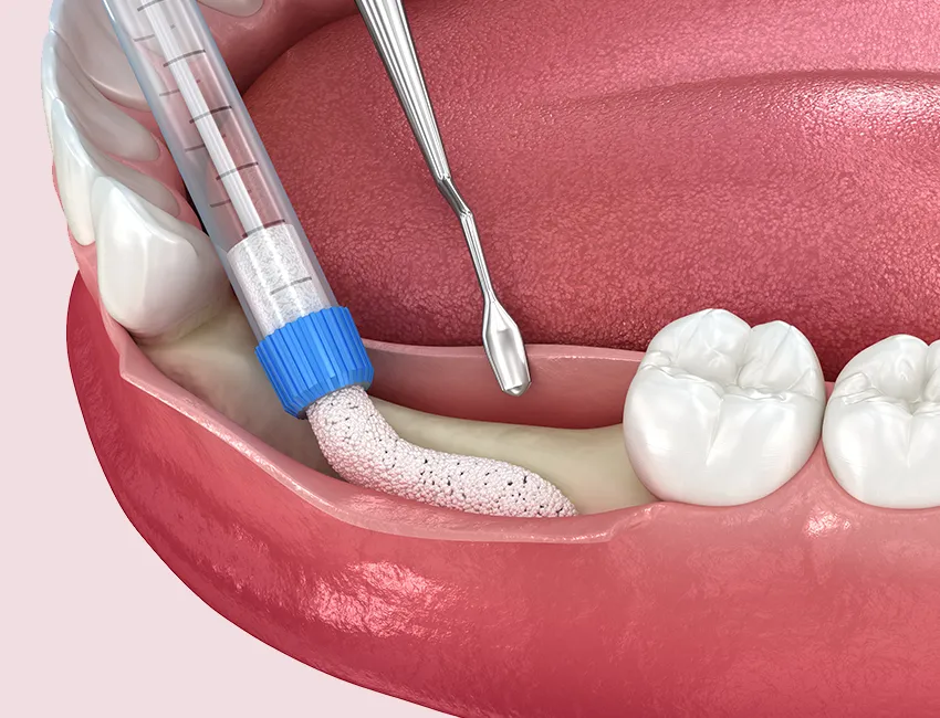 What is Periodontal Bone Regeneration