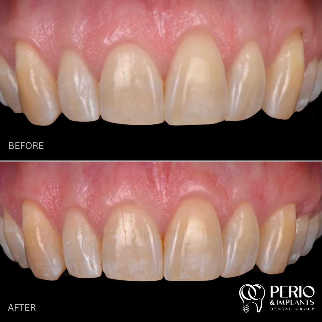 Crown Lengthening - Before and after