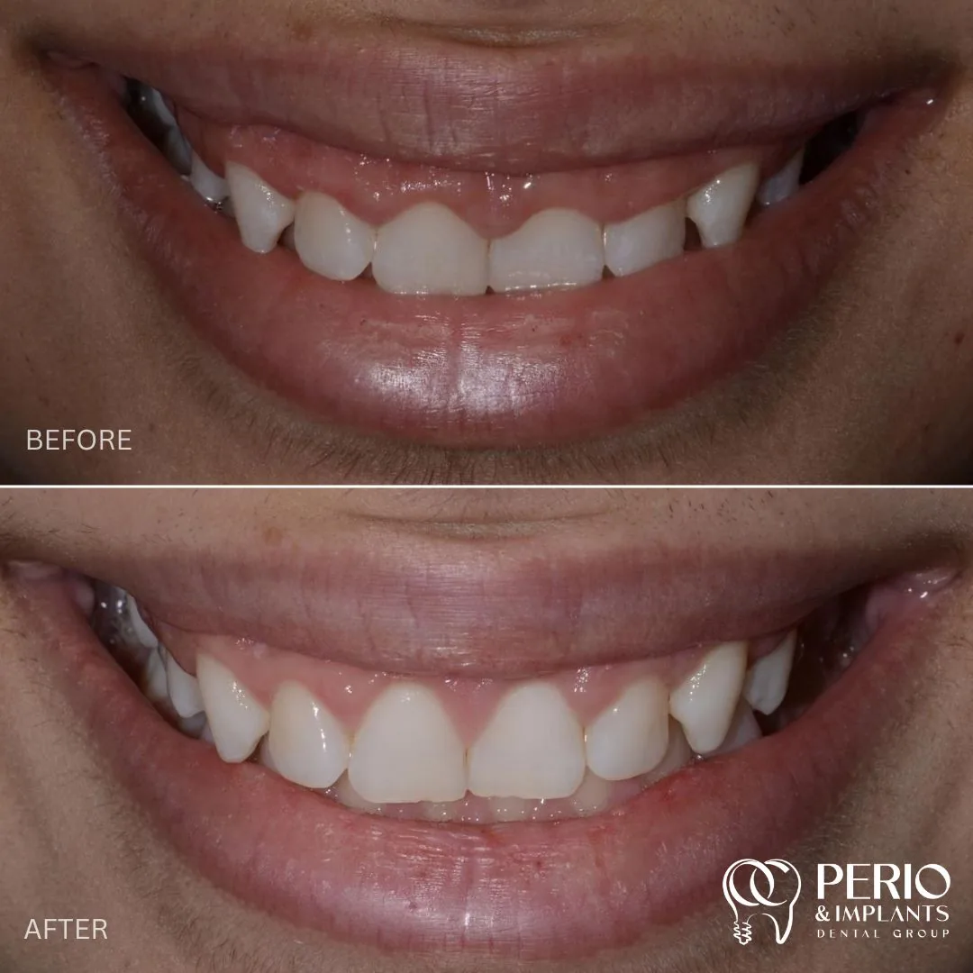 Crown Lengthening - Before and after