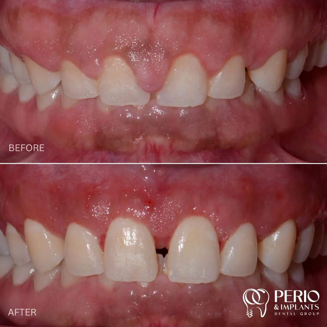 Crown Lengthening - Before and after