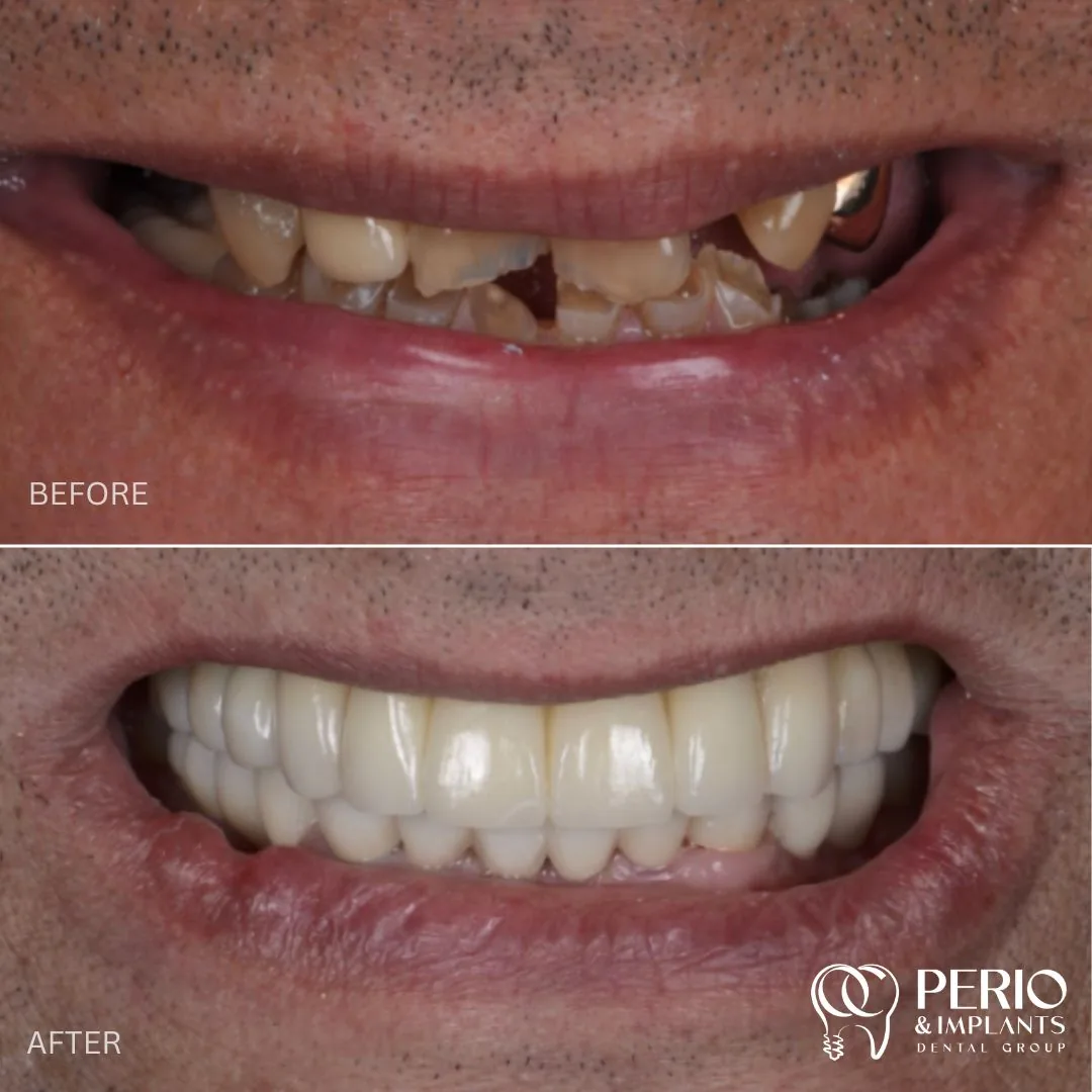 Patient before and after - Dental Implants