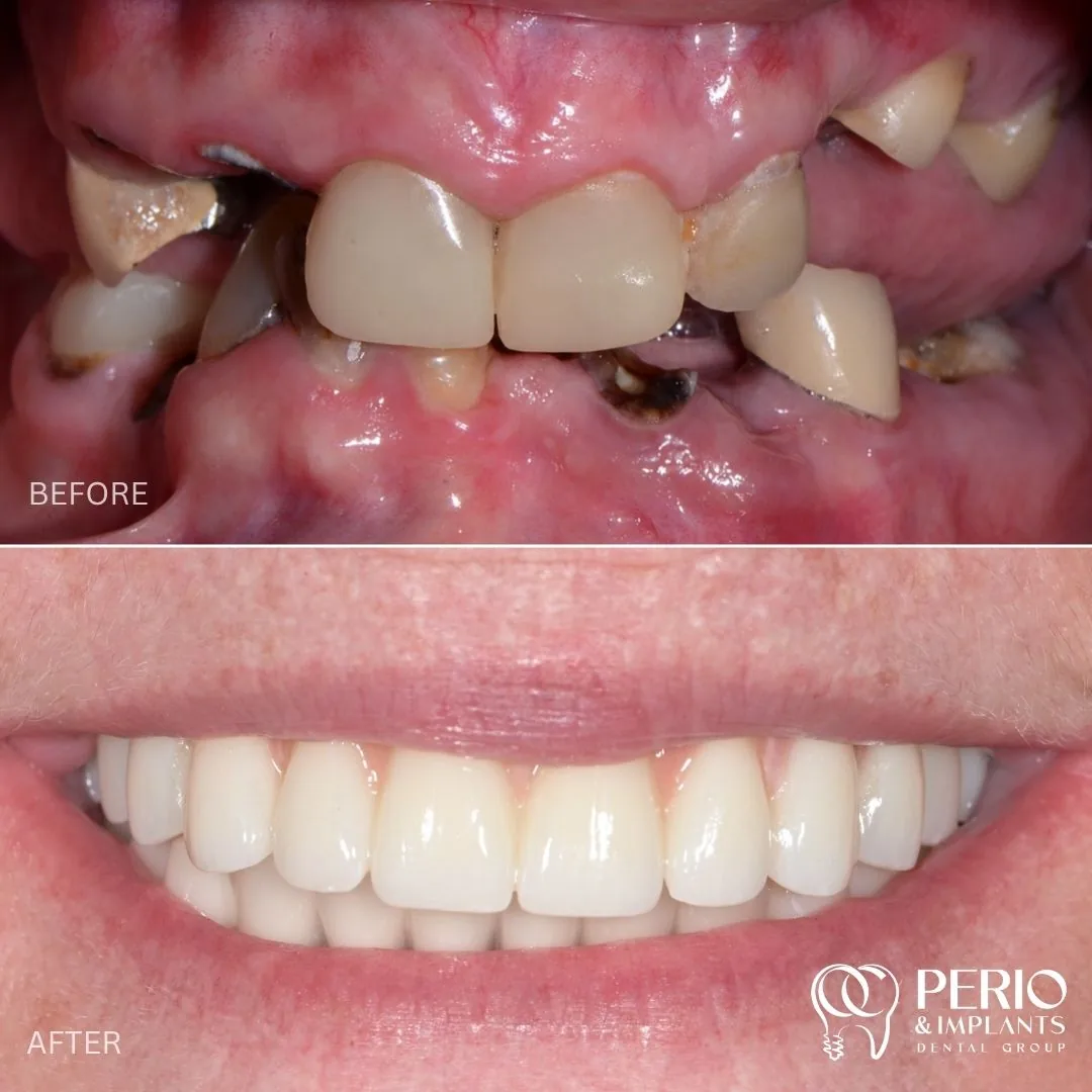 Dental implant case 1 before and after at OC Perio & Implants Dental Group