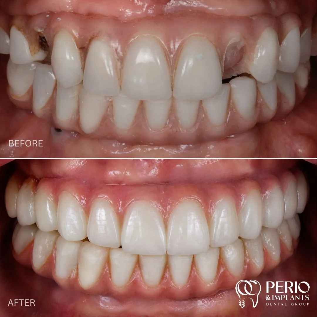 Dental implant case 2 before and after at OC Perio & Implants Dental Group