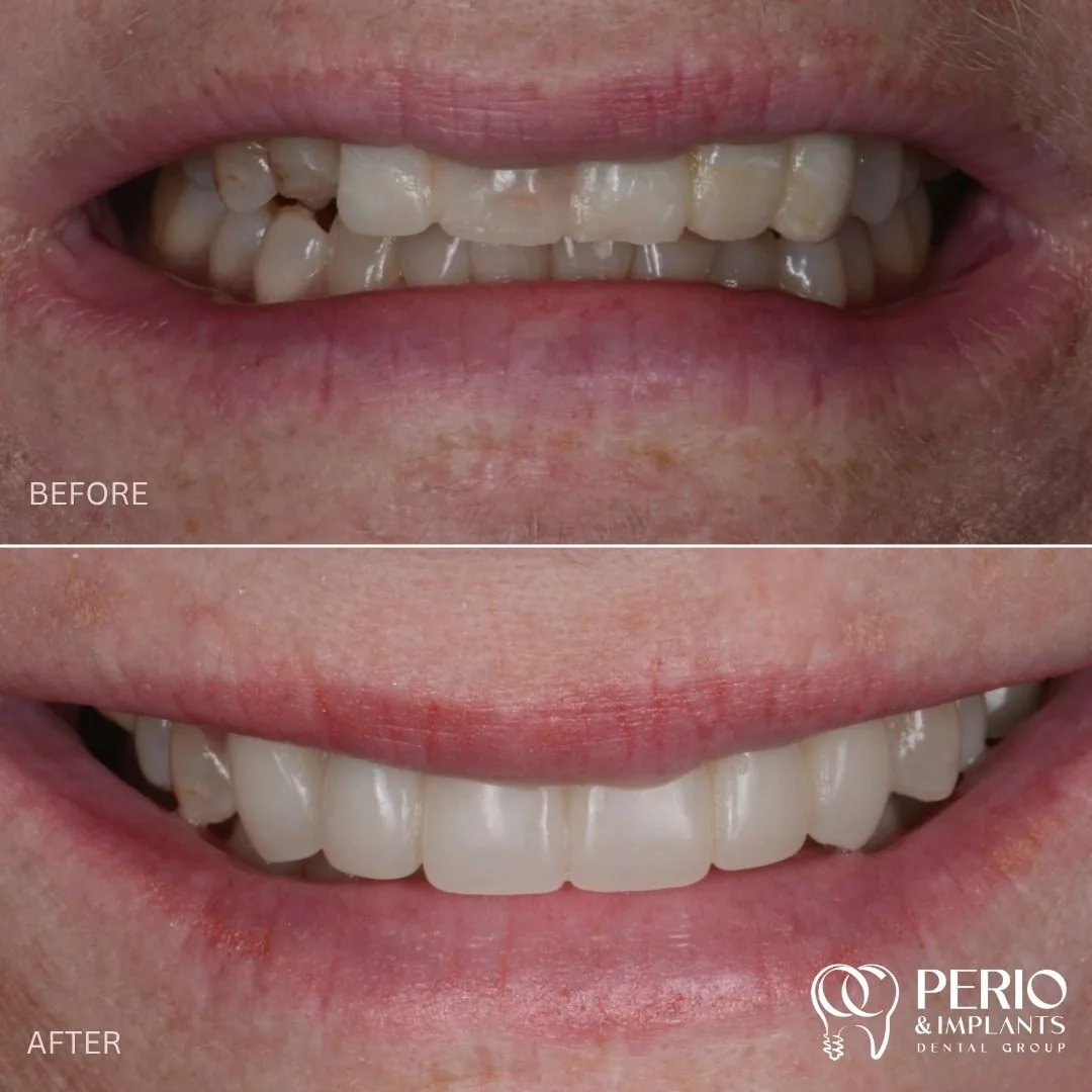 Dental implant case 3 before and after at OC Perio & Implants Dental Group