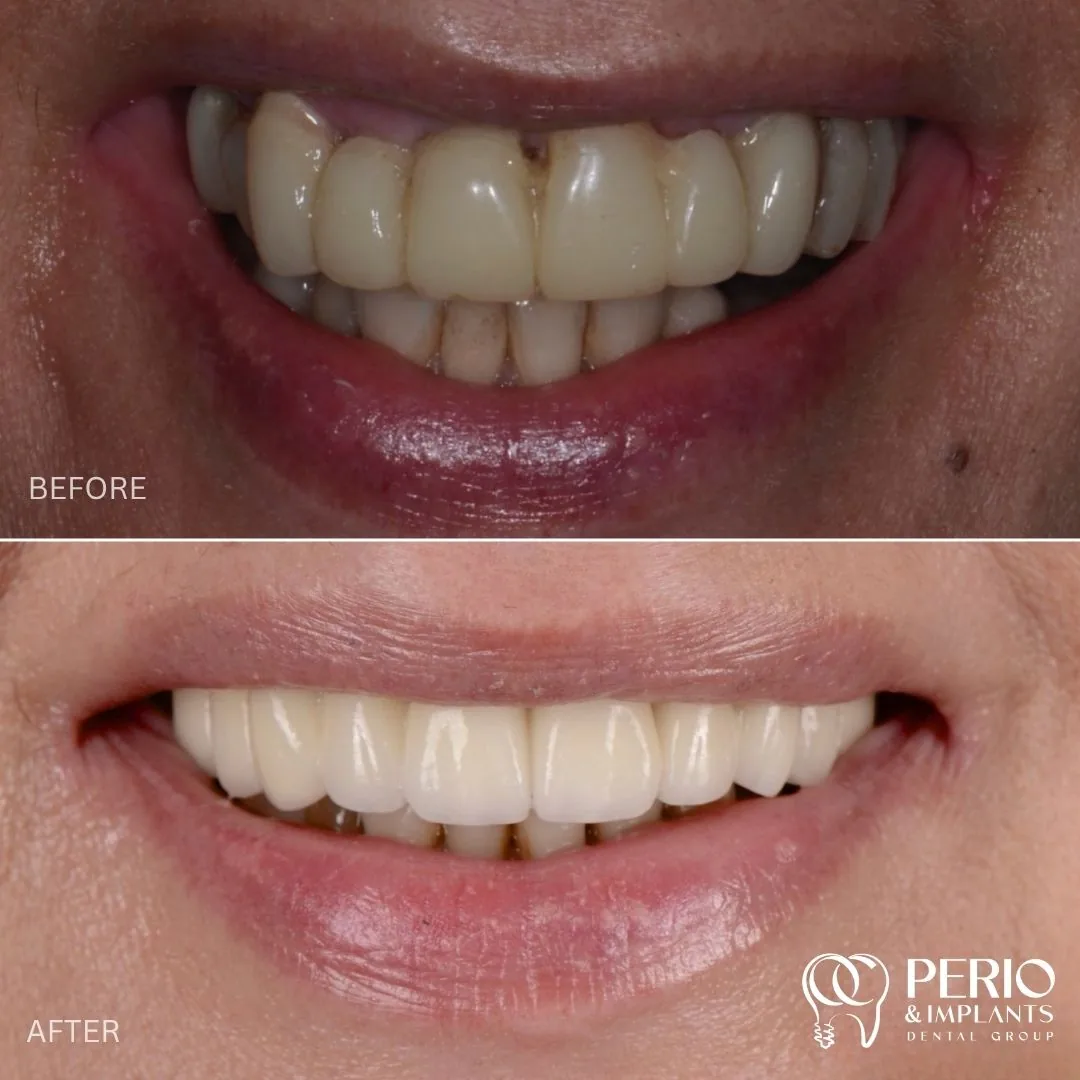 Dental implant case 4 before and after at OC Perio & Implants Dental Group