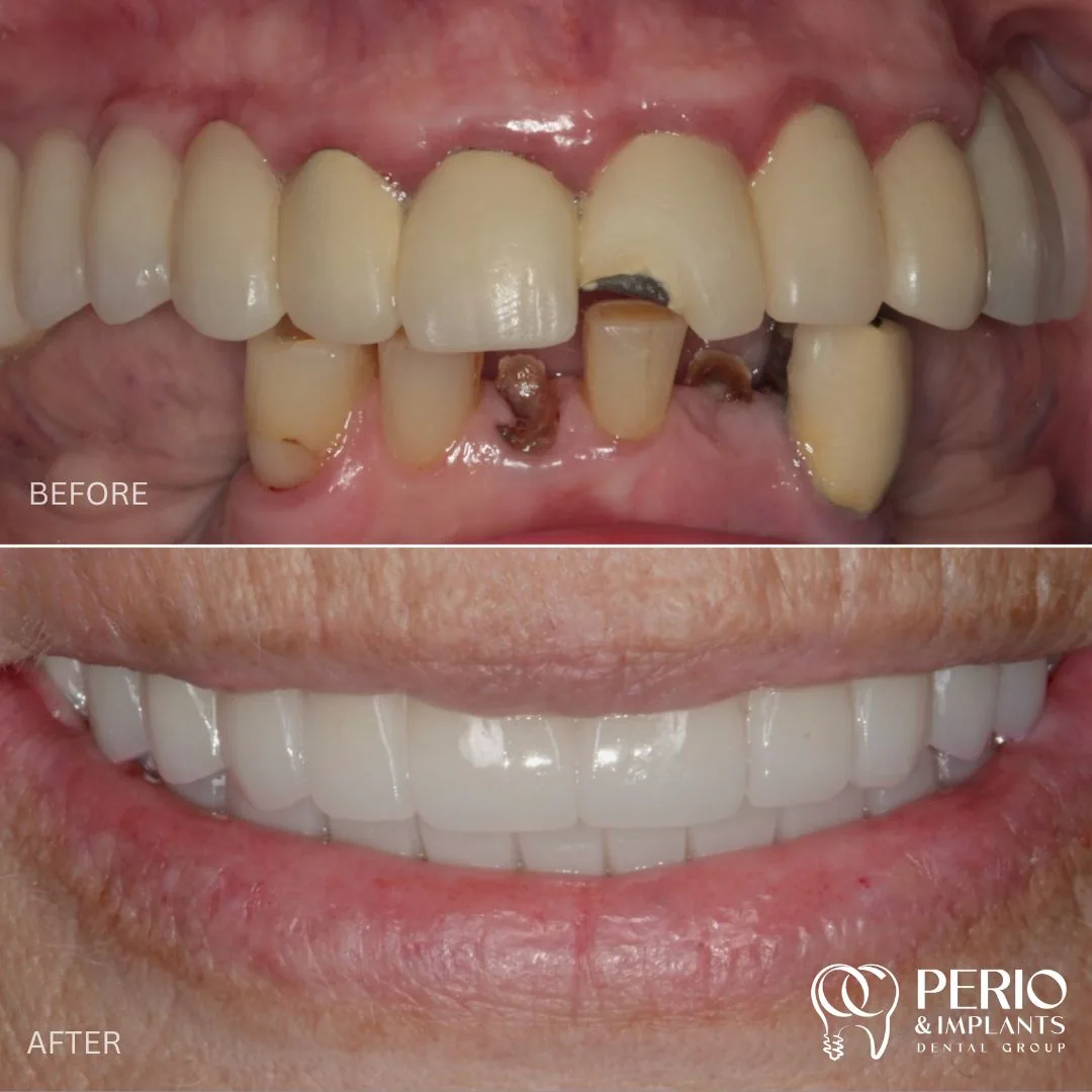 Dental implant case 5 before and after at OC Perio & Implants Dental Group