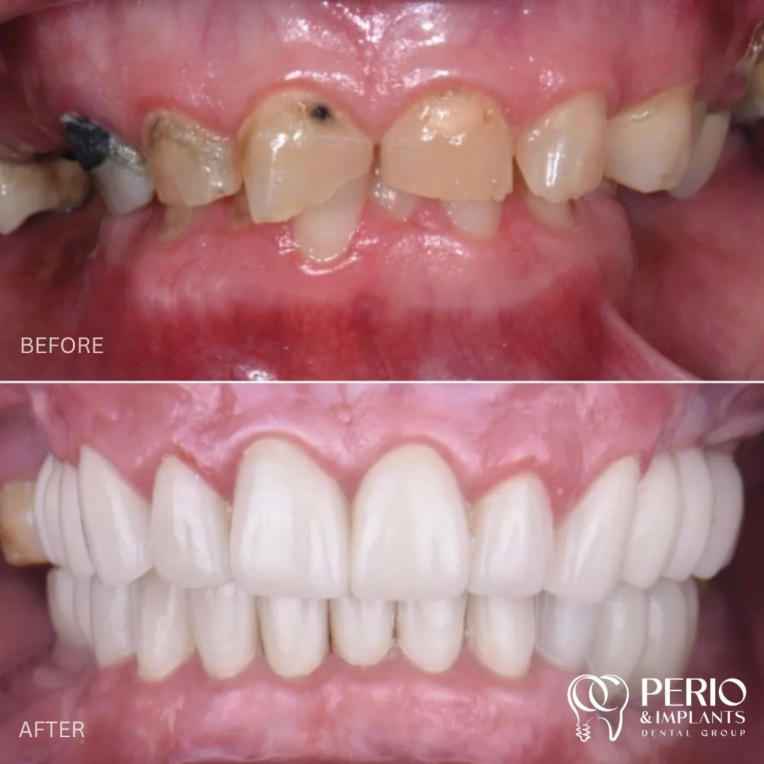 Dental implant case 6 before and after at OC Perio & Implants Dental Group