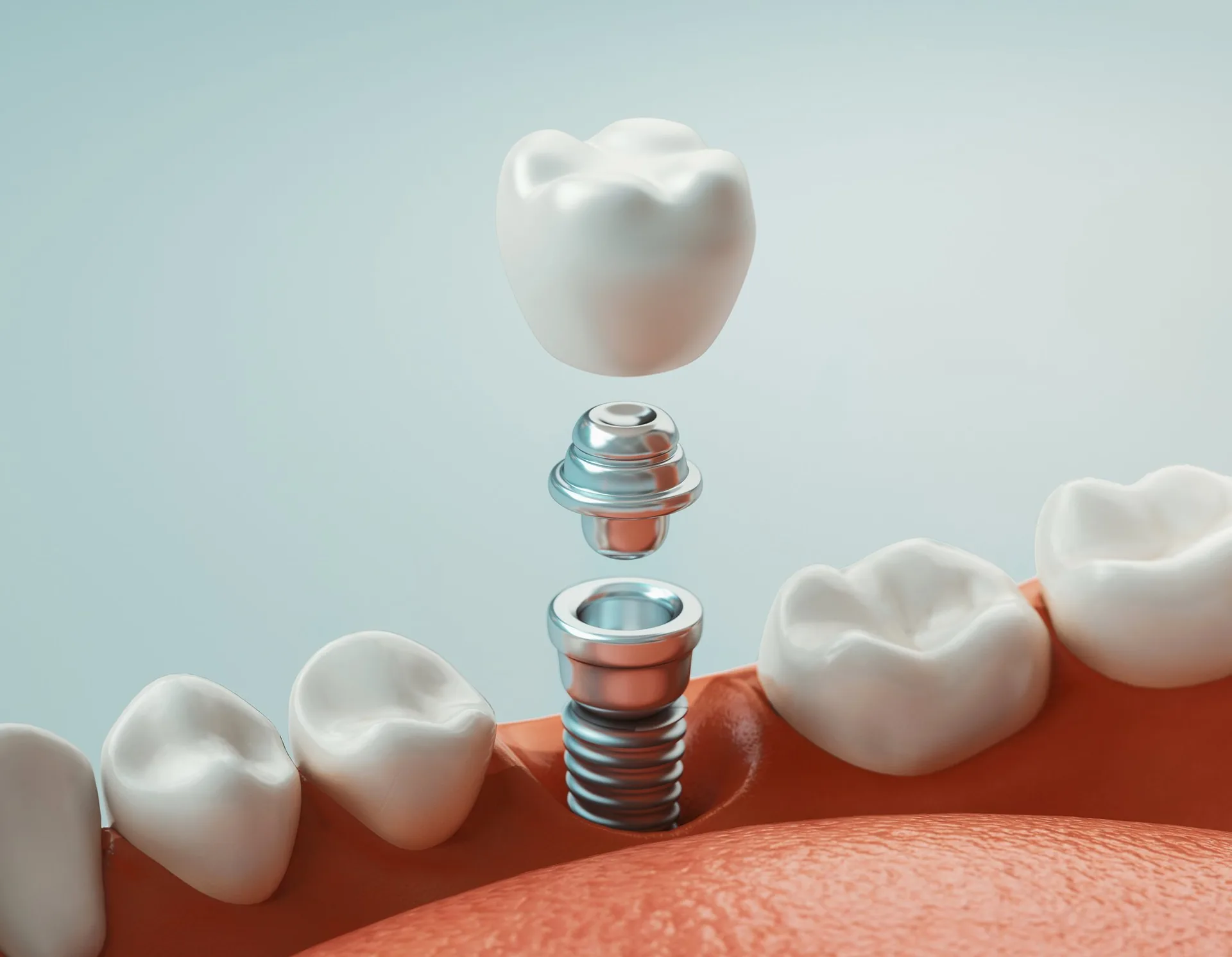 dental implants demonstration