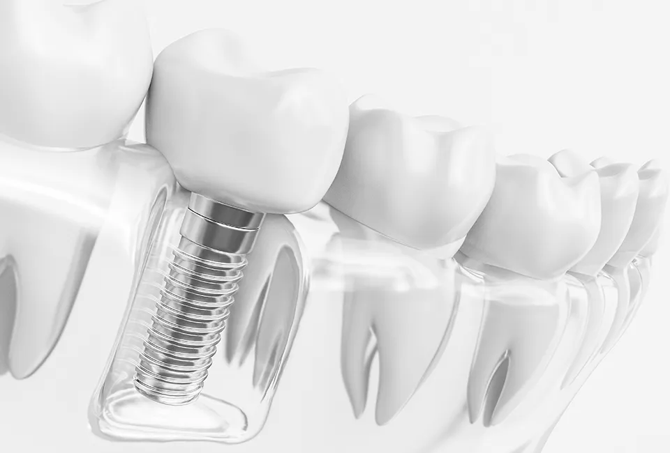 dental implants