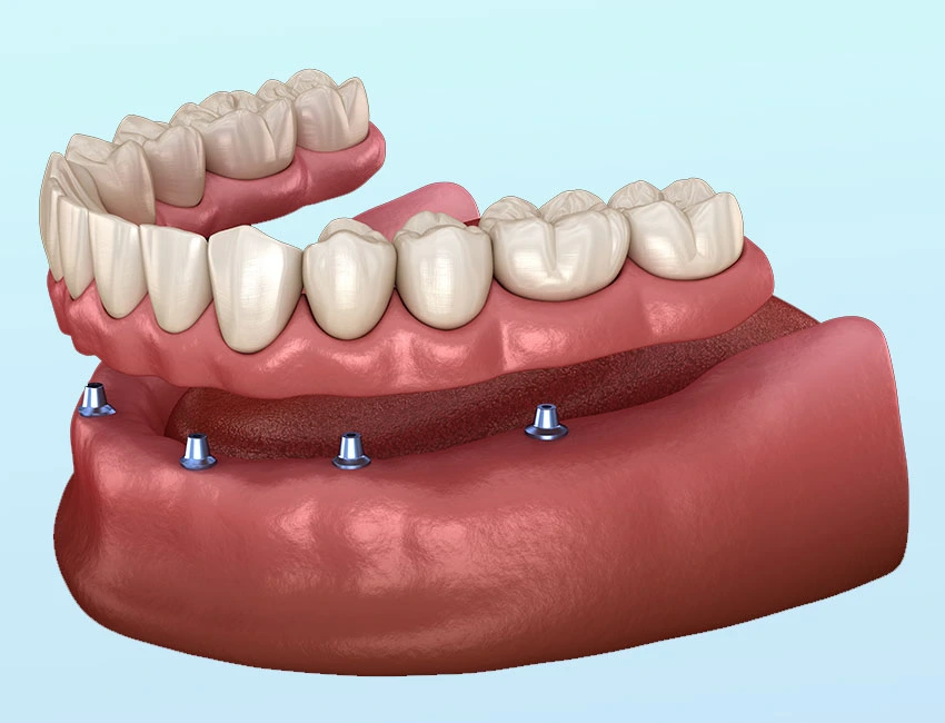 Snap-In Dentures