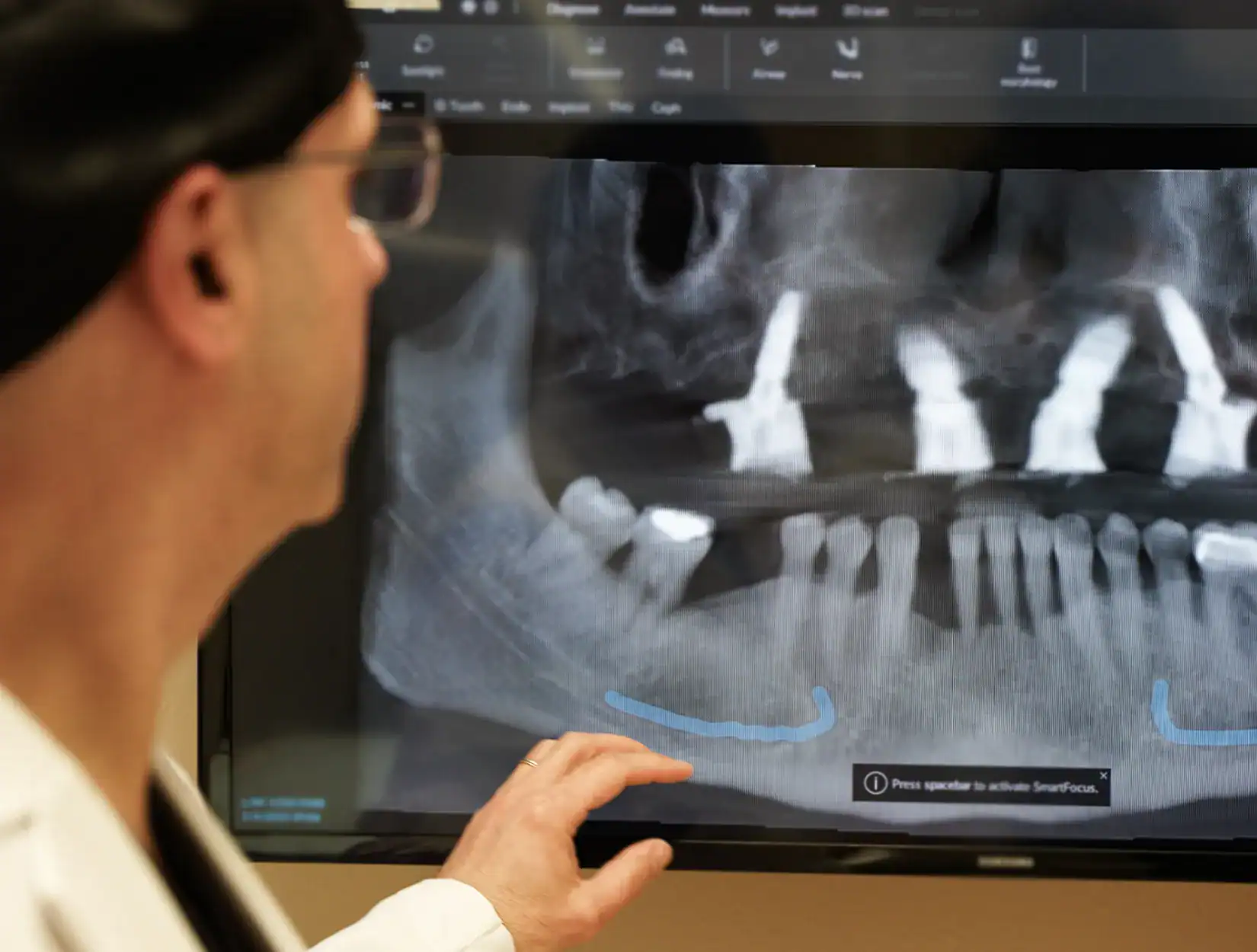 The benefits of Dental Implants