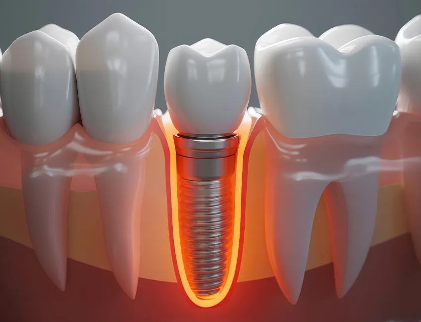 The benefits of Dental Implant Complication