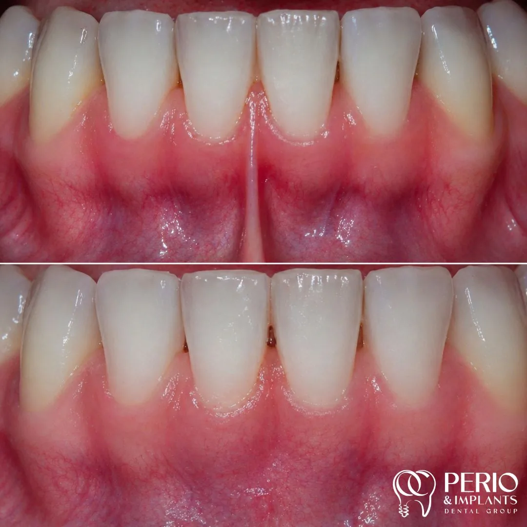 Frenectomies - Before and after