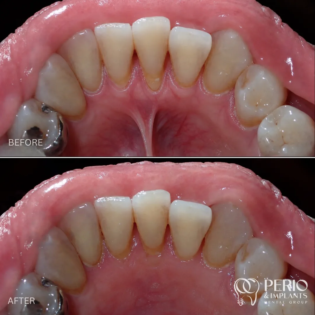Frenectomies - Before and after