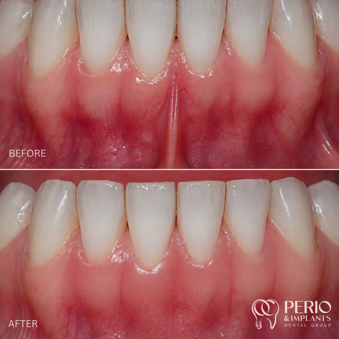 Frenectomies - Before and after