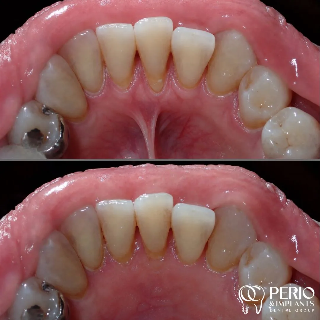 Frenectomies - Before and after