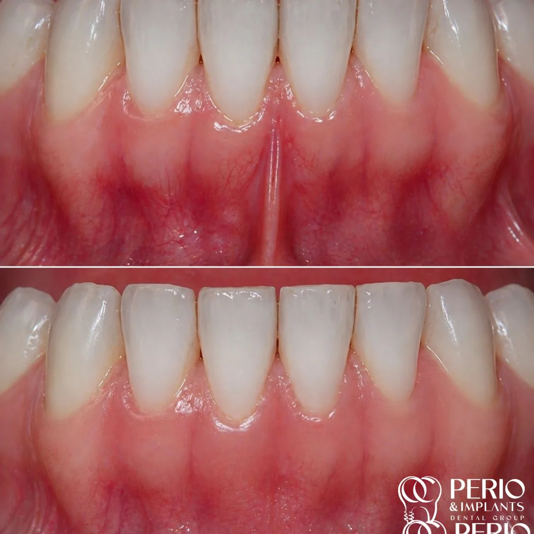 Frenectomies - Before and after
