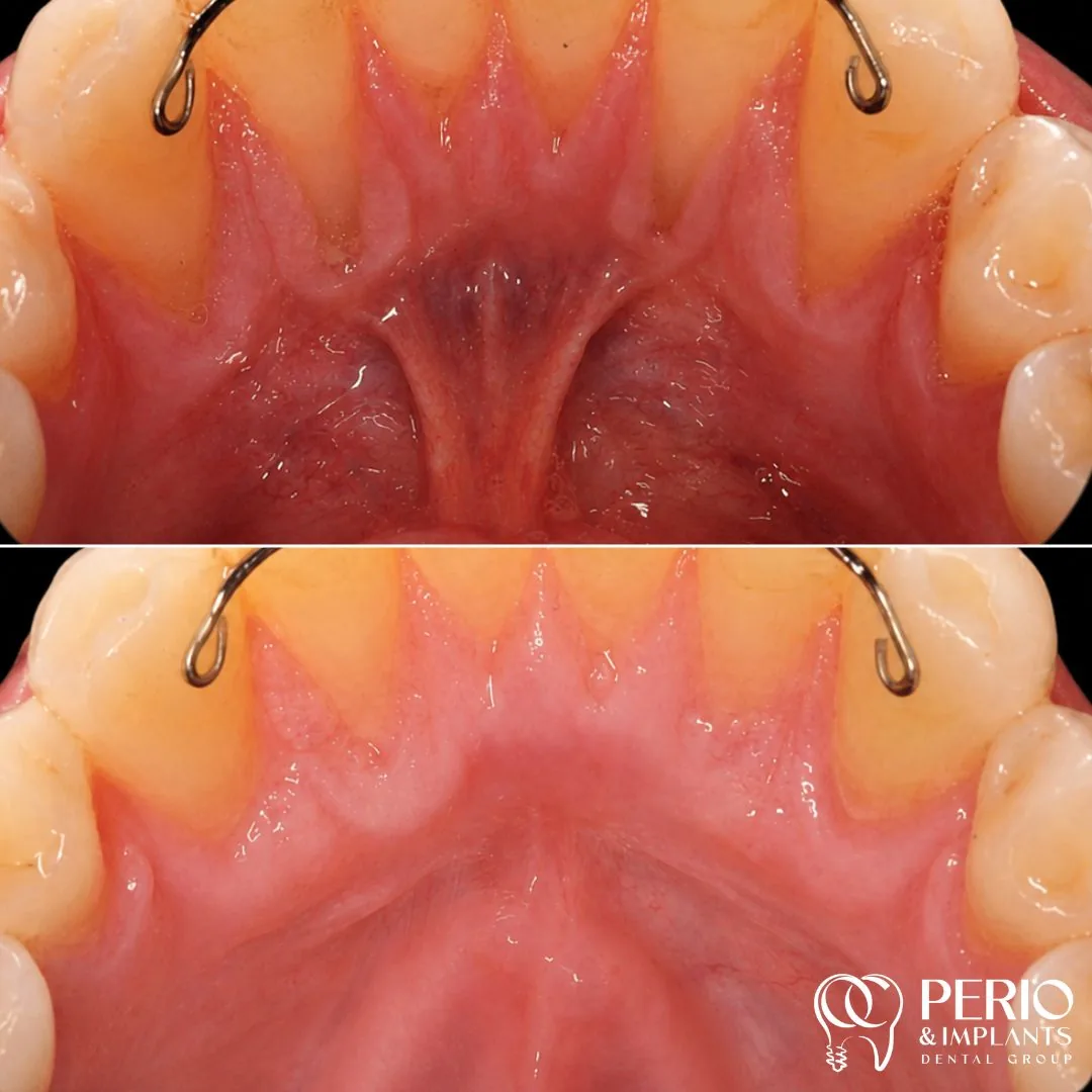 Frenectomies - Before and after
