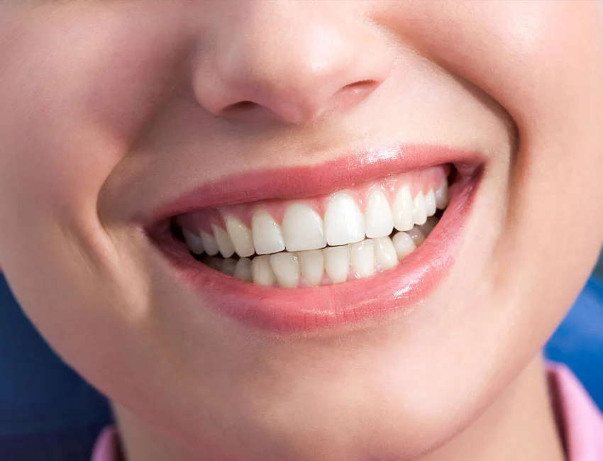 What is Gum Bleaching
