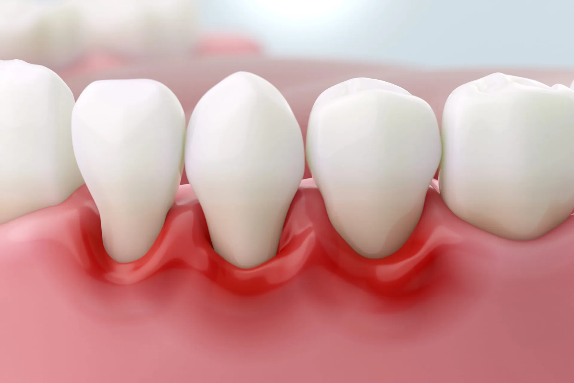 Gum recession model