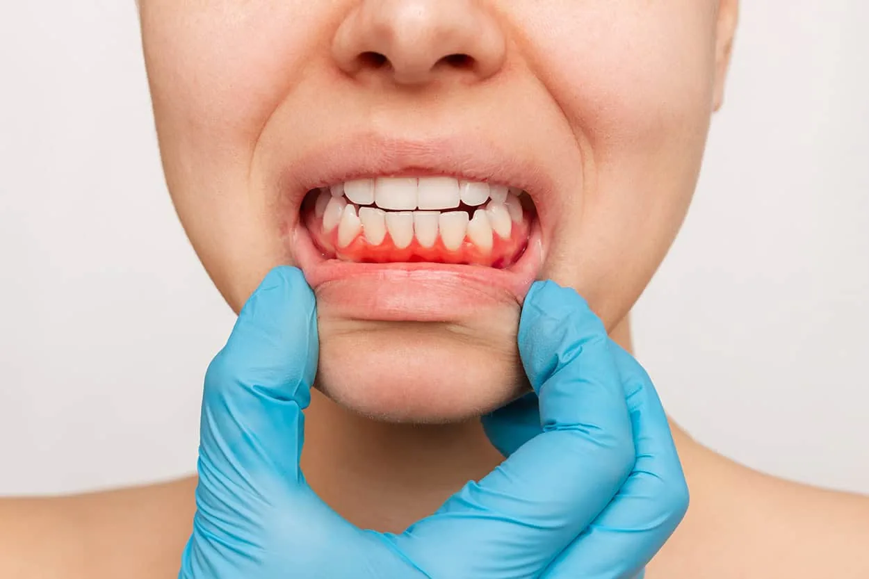 woman with gums receding