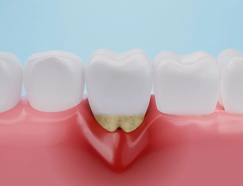 What is About Gum Disease