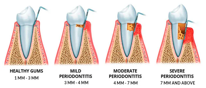 Gum Disease pocket size