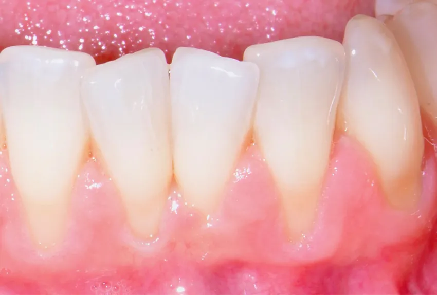 The benefits of Gum Recession Treatments