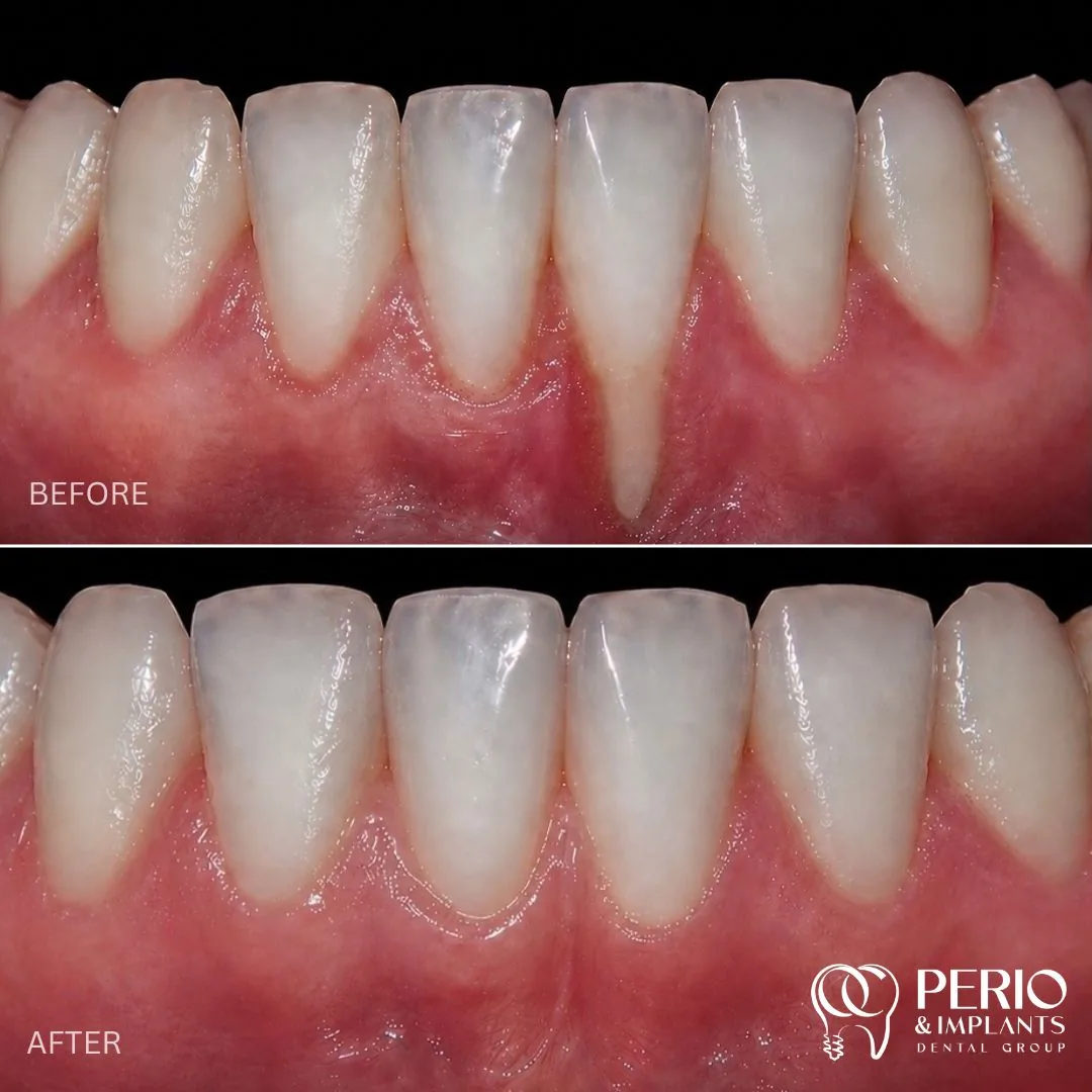 Gum recession treatment case 1 before and after at OC Perio & Implants Dental Group