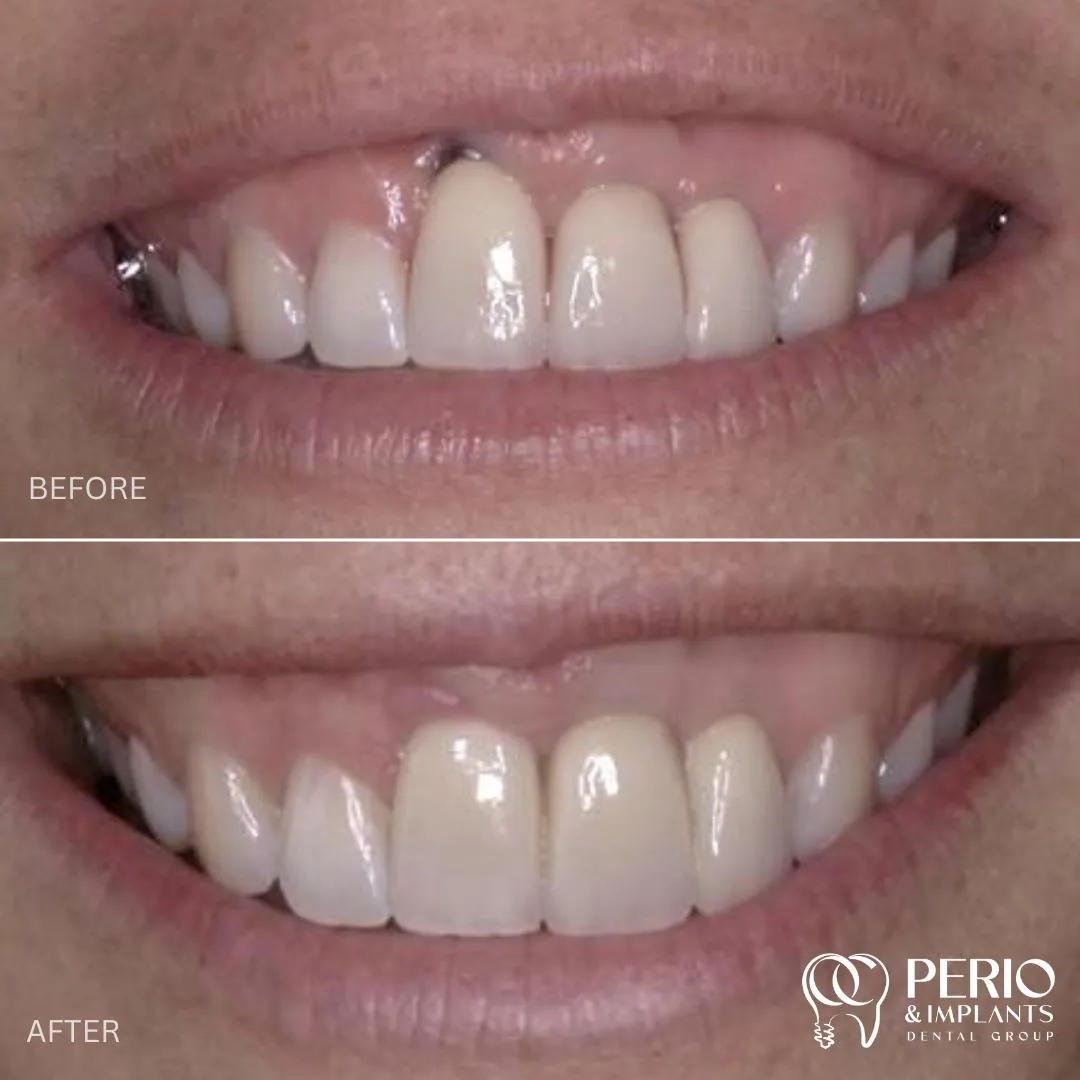 Before and after - Gingival Recessions