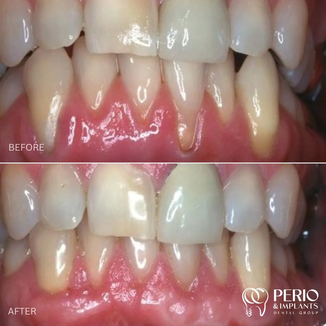 Before and after - Gingival Recessions