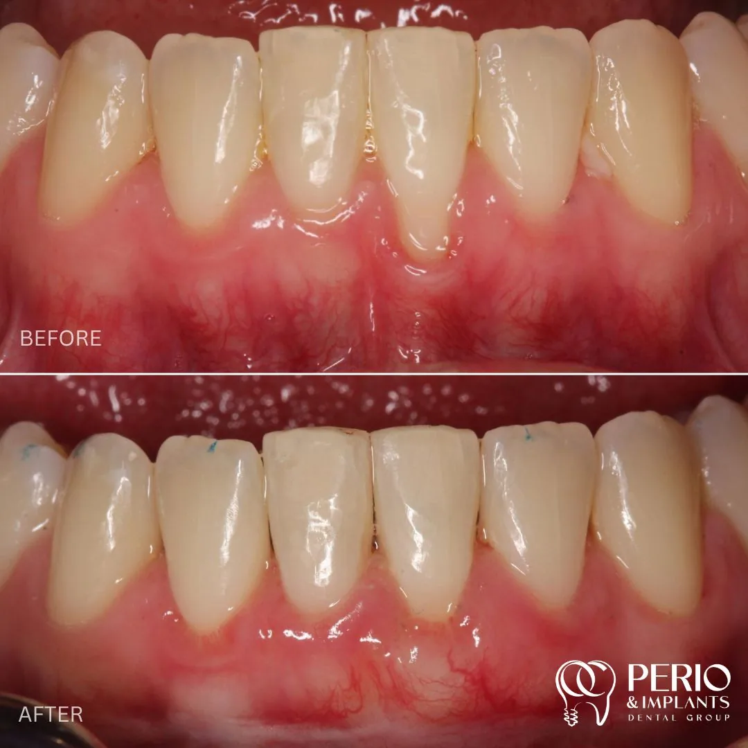 Before and after - Gingival Recessions