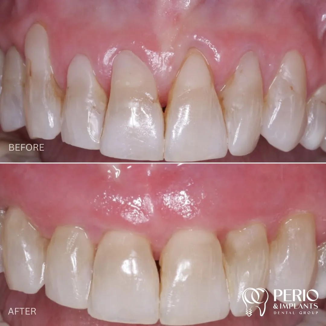 Before and after - Gingival Recessions