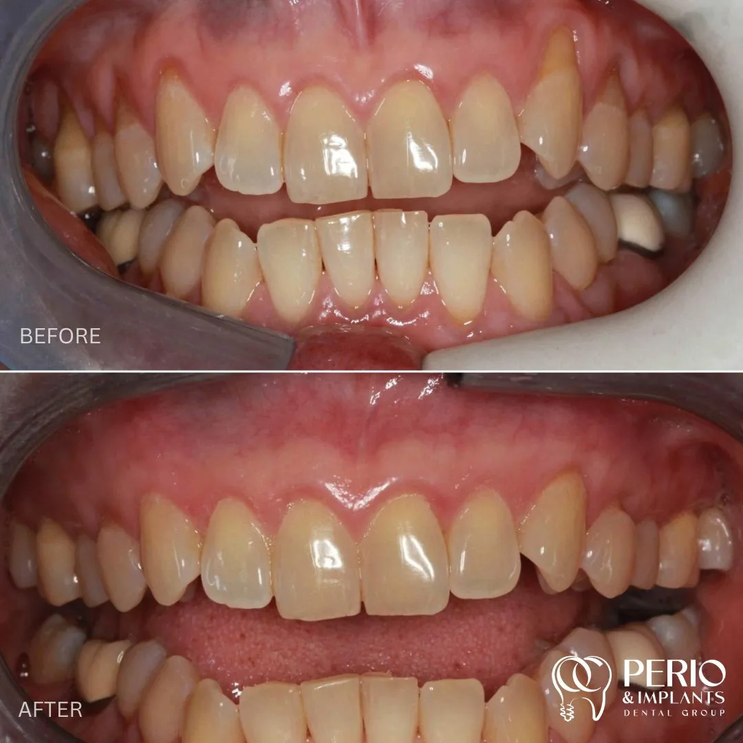 Before and after - Gingival Recessions