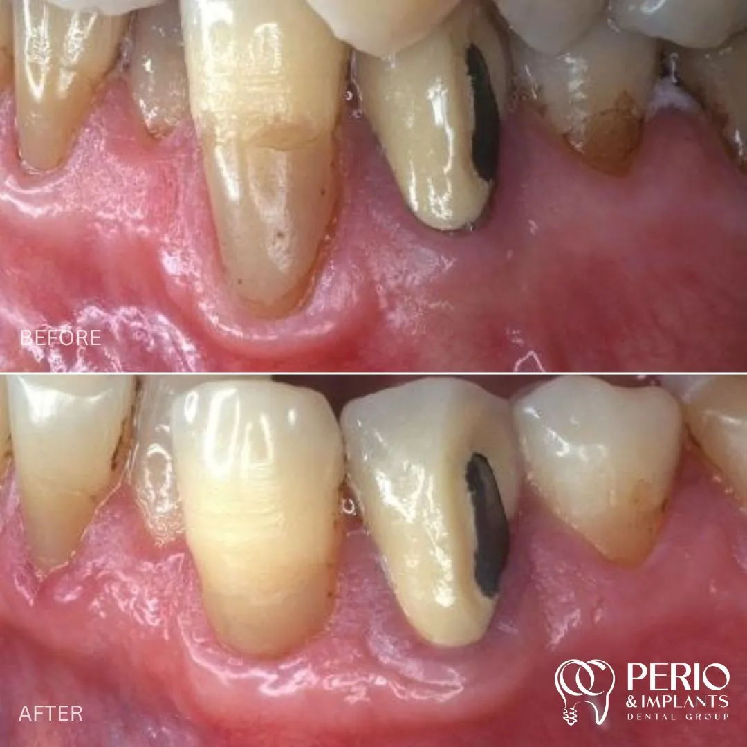 Before and after - Gingival Recessions