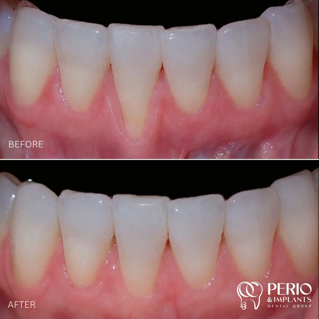 Before and after - Gingival Recessions