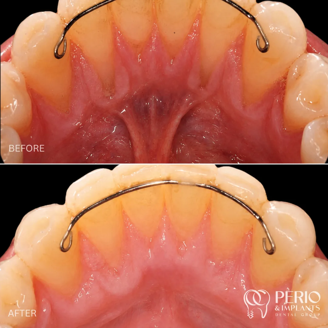 Gum recession treatment case 2 before and after at OC Perio & Implants Dental Group