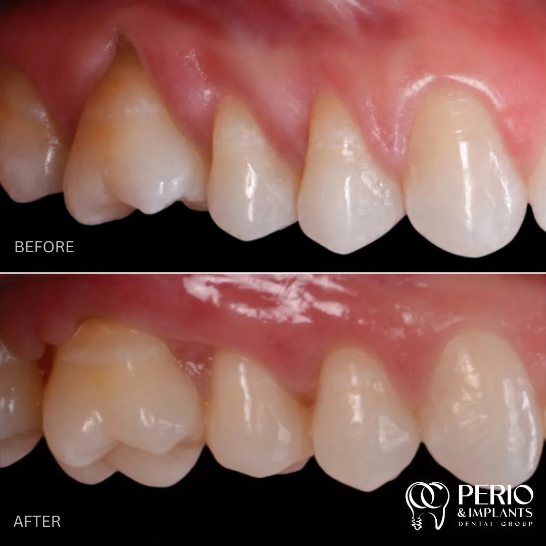Before and after - Gingival Recessions