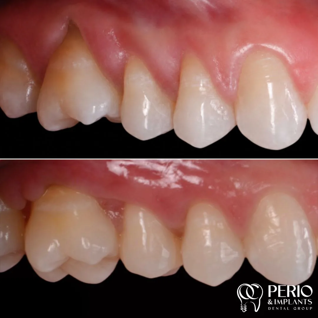 Gum recession treatment case 3 before and after at OC Perio & Implants Dental Group