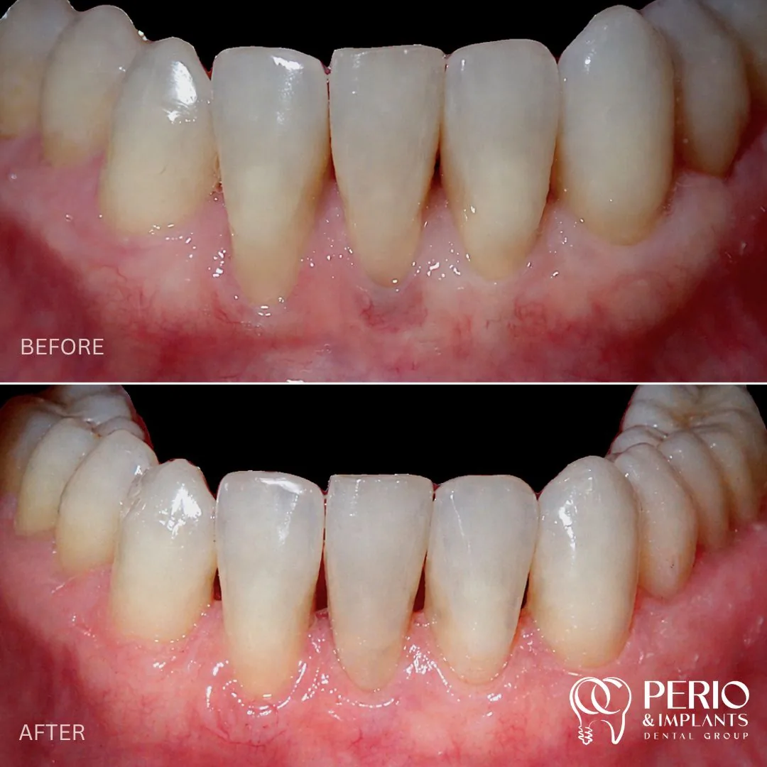 Before and after - Gingival Recessions