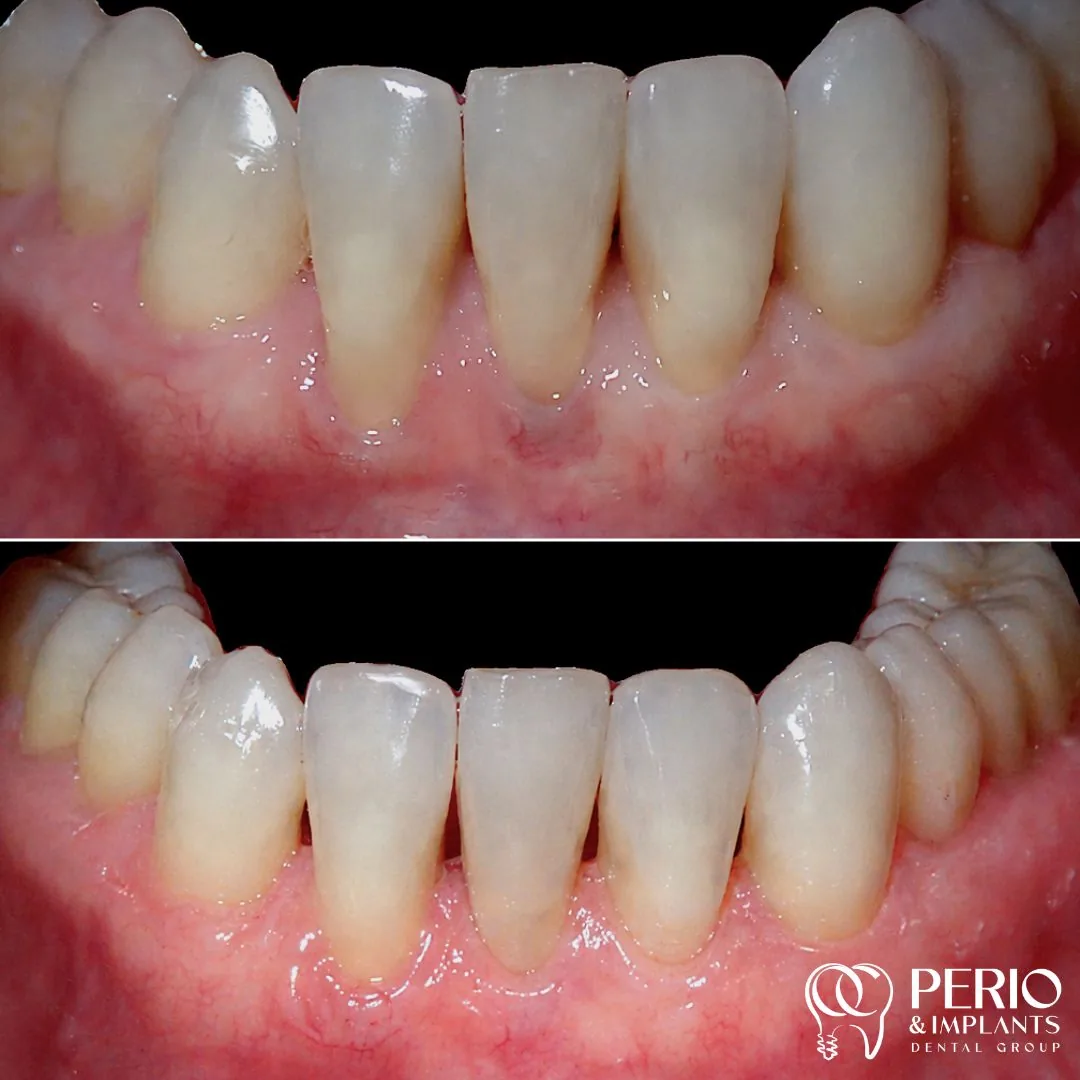 Gum recession treatment case 4 before and after at OC Perio & Implants Dental Group