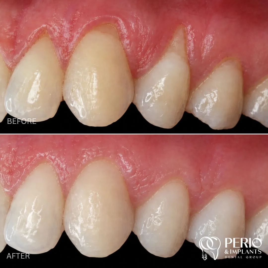 Before and after - Gingival Recessions