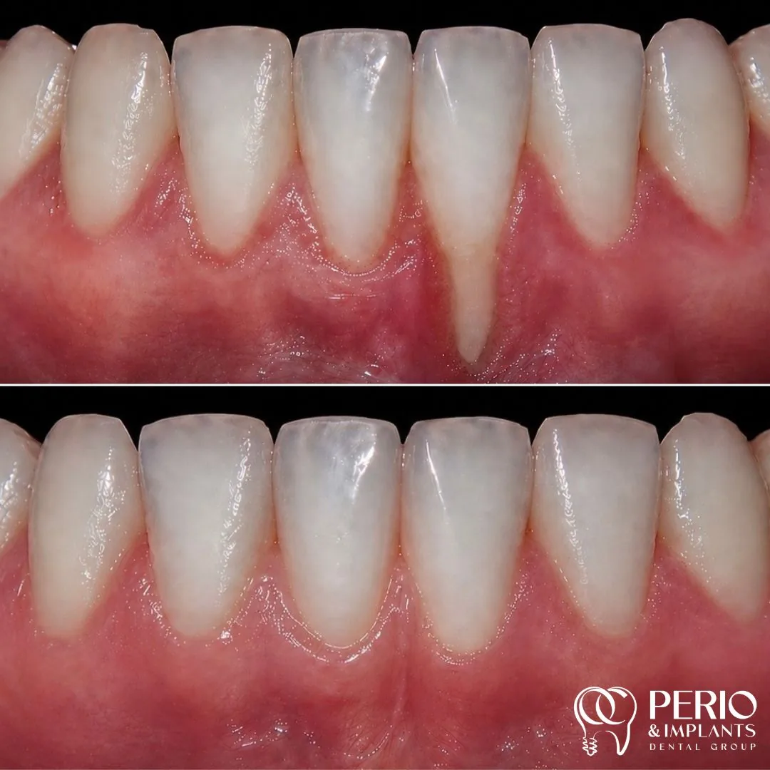 Gum recession treatment case 5 before and after at OC Perio & Implants Dental Group
