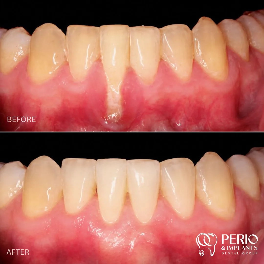 Gum recession treatment case 6 before and after at OC Perio & Implants Dental Group